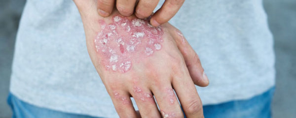 le psoriasis