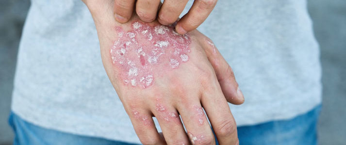 le psoriasis